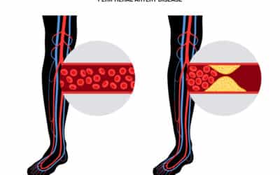 Know The Facts About Peripheral Artery Disease And Protect Your Limbs