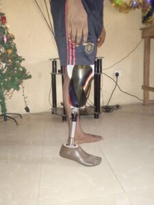Abiodun Soniran prosthetic leg